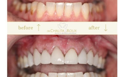 Smile Makeover Johannesburg (2025 Costs & Options) | Dr Chalita