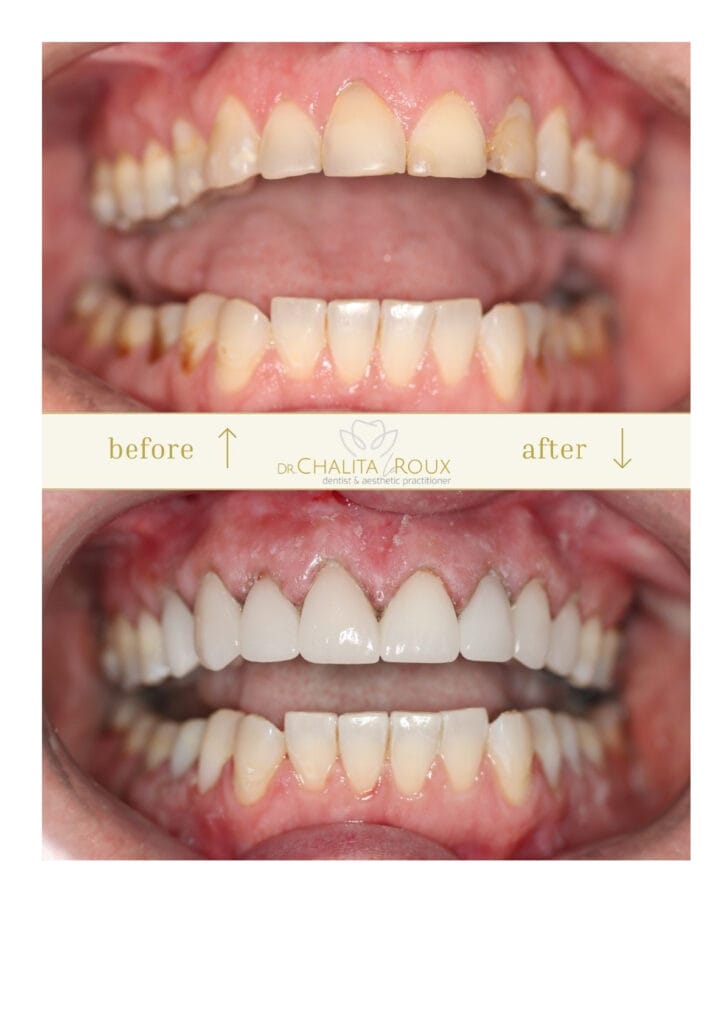 smile makeover johannesburg before after