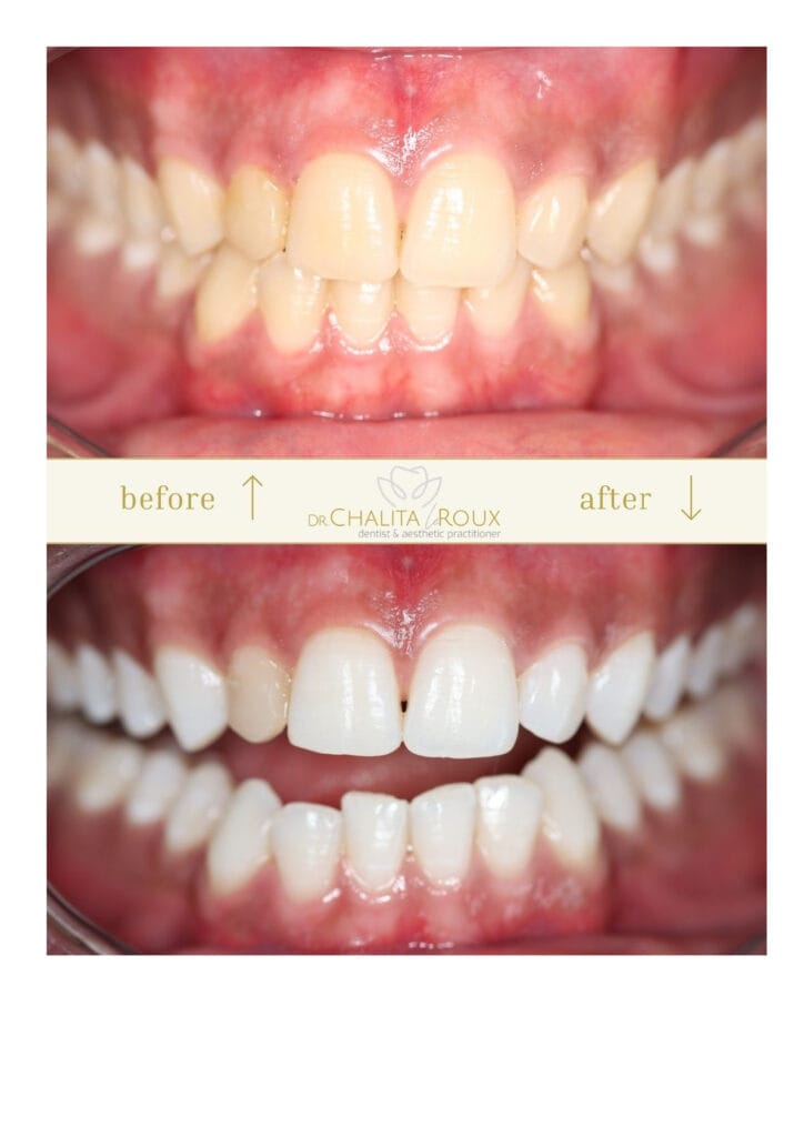 Teeth Whitening Johannesburg before after biolase laser
