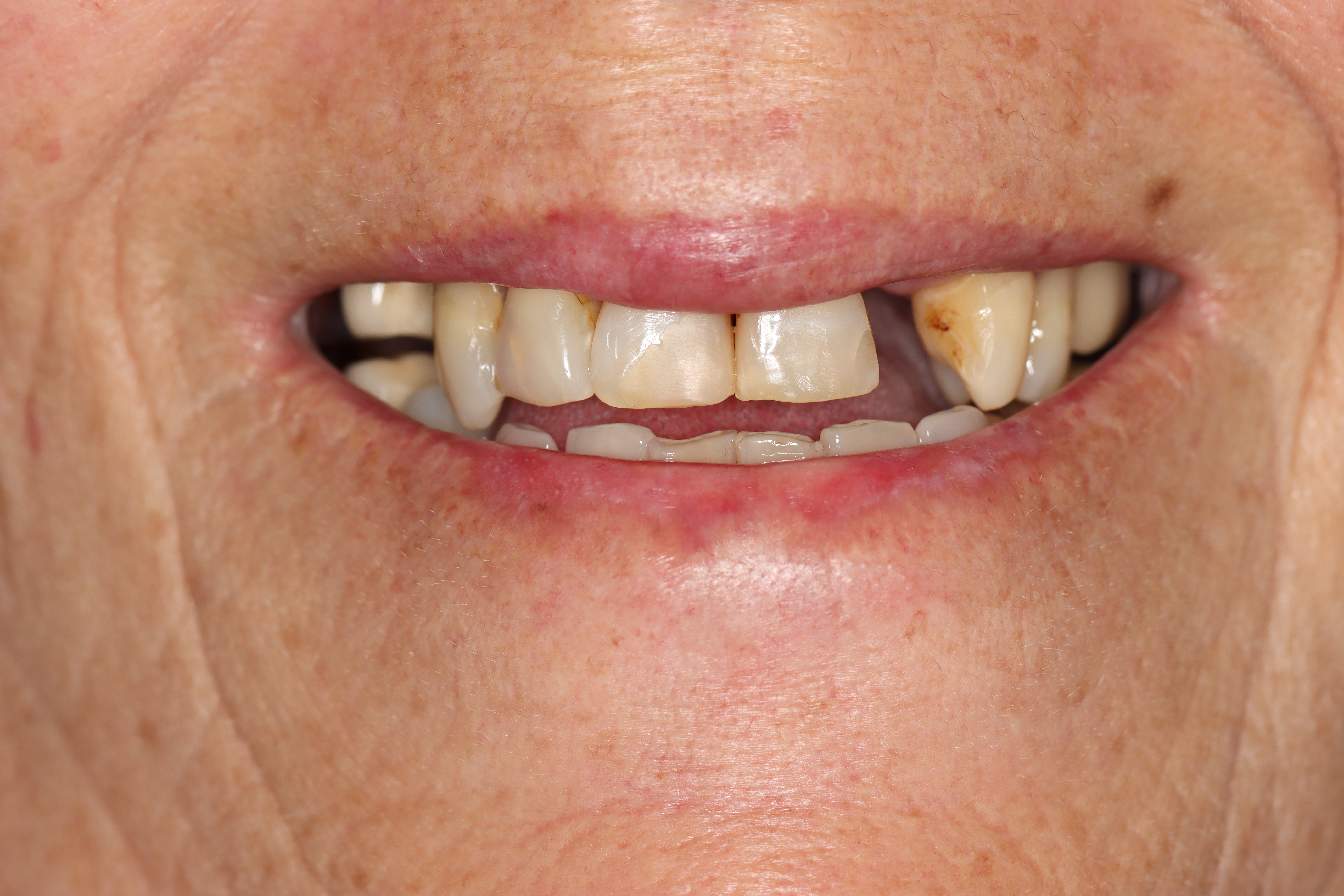 Cosmetic Dentistry: Dental Bridge & Dental Crowns before at Dr Chalita le Roux, Roodepoort (view 1)