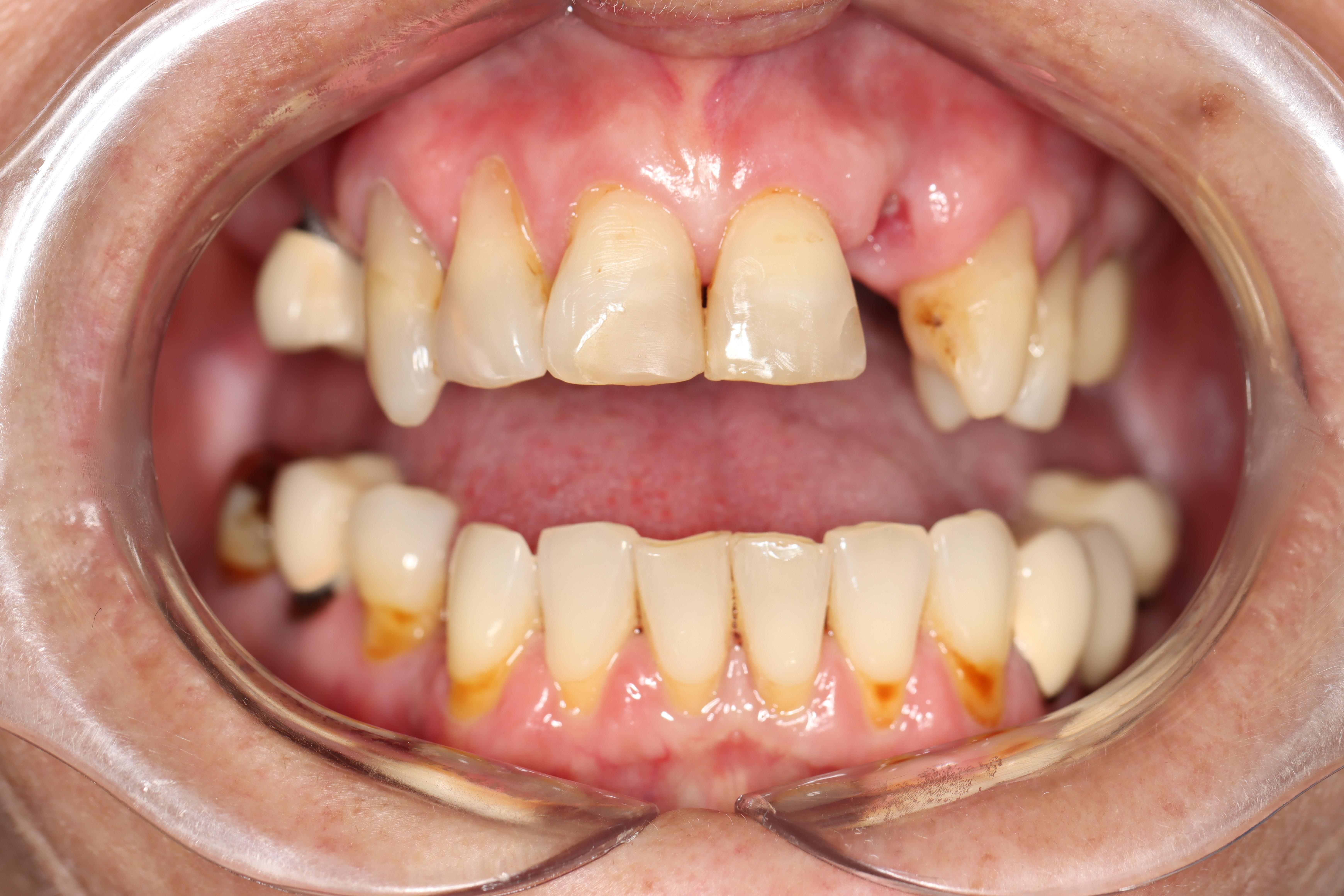 Cosmetic Dentistry: Dental Bridge & Dental Crowns before at Dr Chalita le Roux, Roodepoort (view 2)