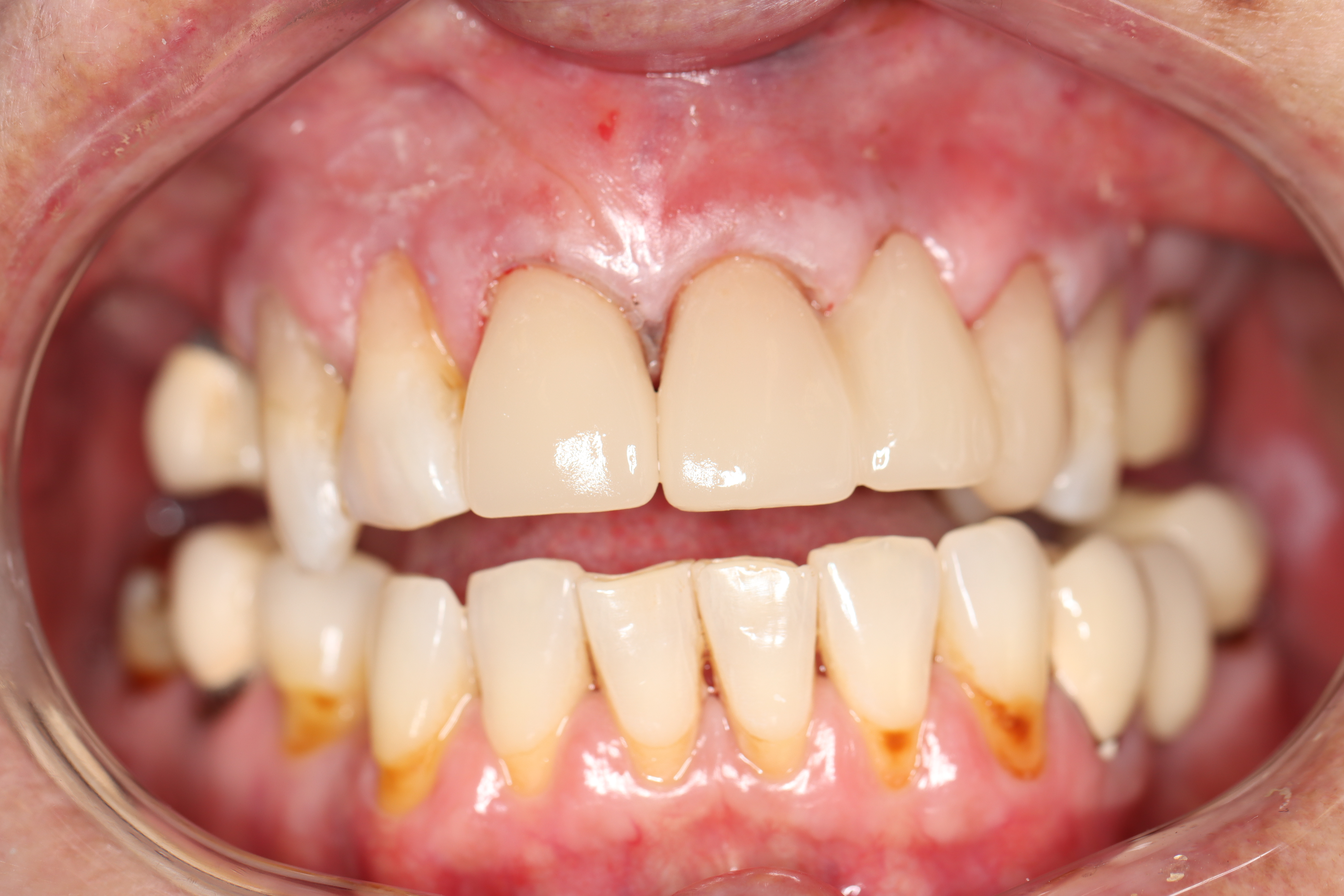 Cosmetic Dentistry: Dental Bridge & Dental Crowns after at Dr Chalita le Roux, Roodepoort (view 1)