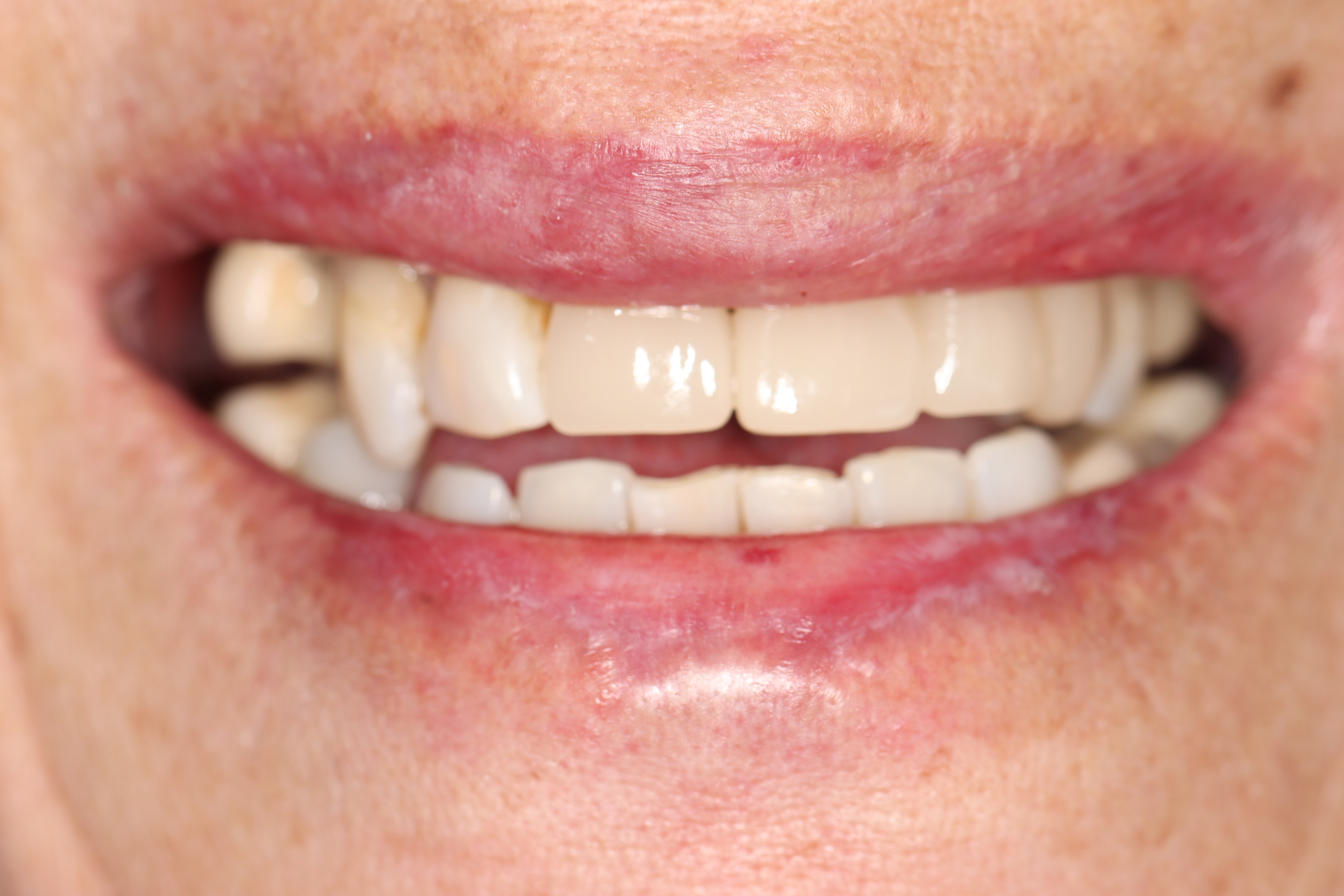 Cosmetic Dentistry: Dental Bridge & Dental Crowns after at Dr Chalita le Roux, Roodepoort (view 2)