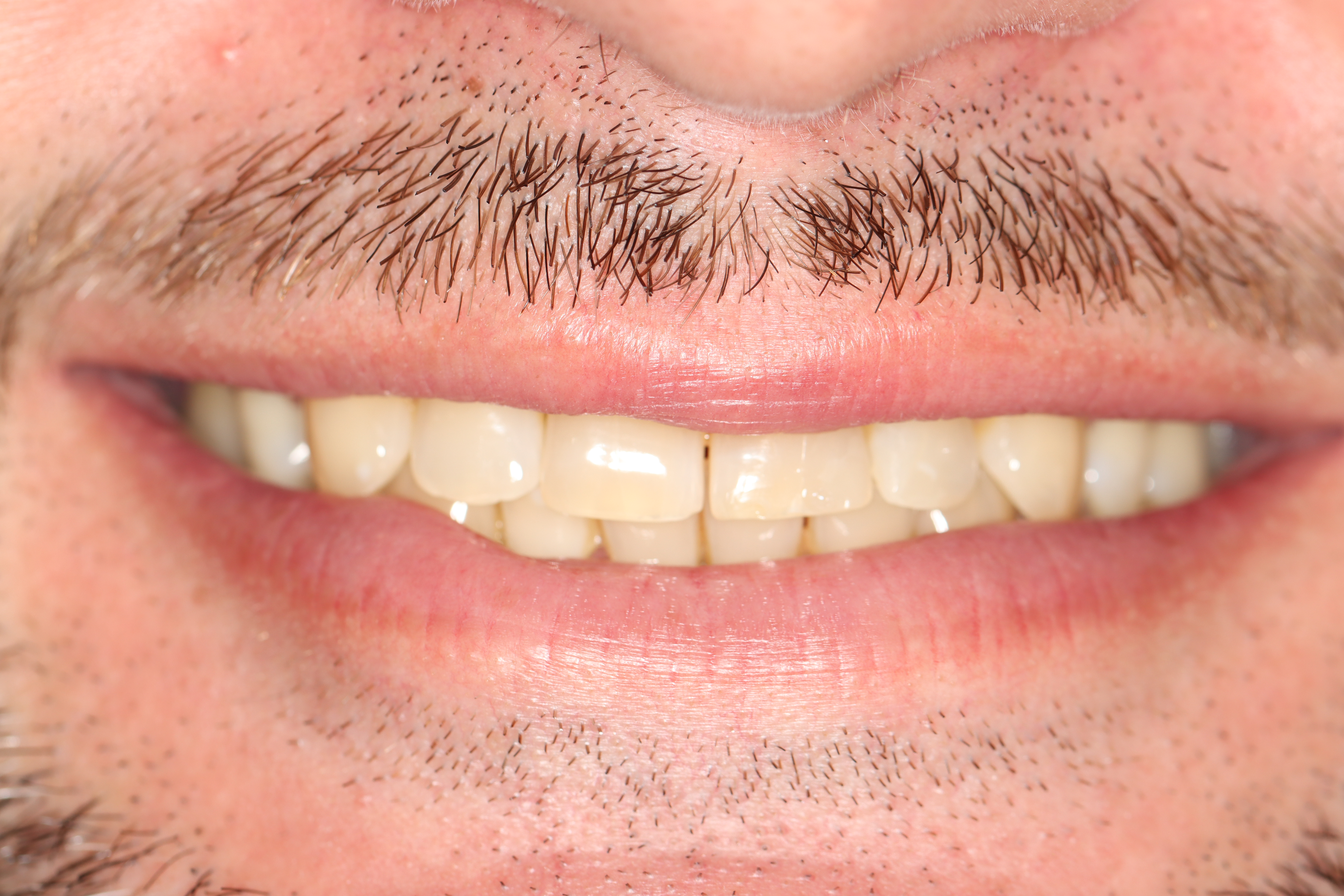 Cosmetic Dentistry: Dental Crowns before at Dr Chalita le Roux, Roodepoort (view 1)