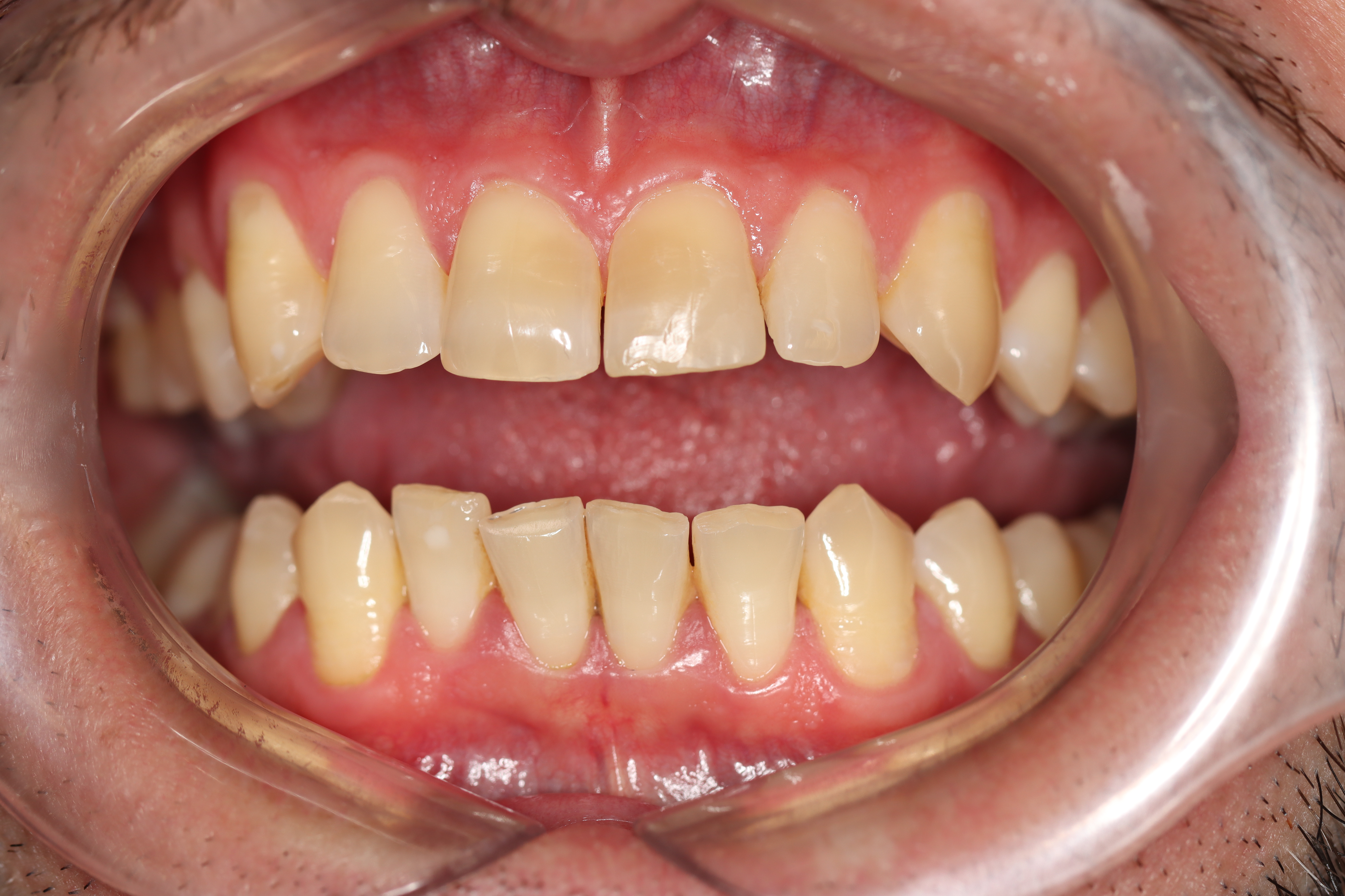 Cosmetic Dentistry: Dental Crowns before at Dr Chalita le Roux, Roodepoort (view 2)