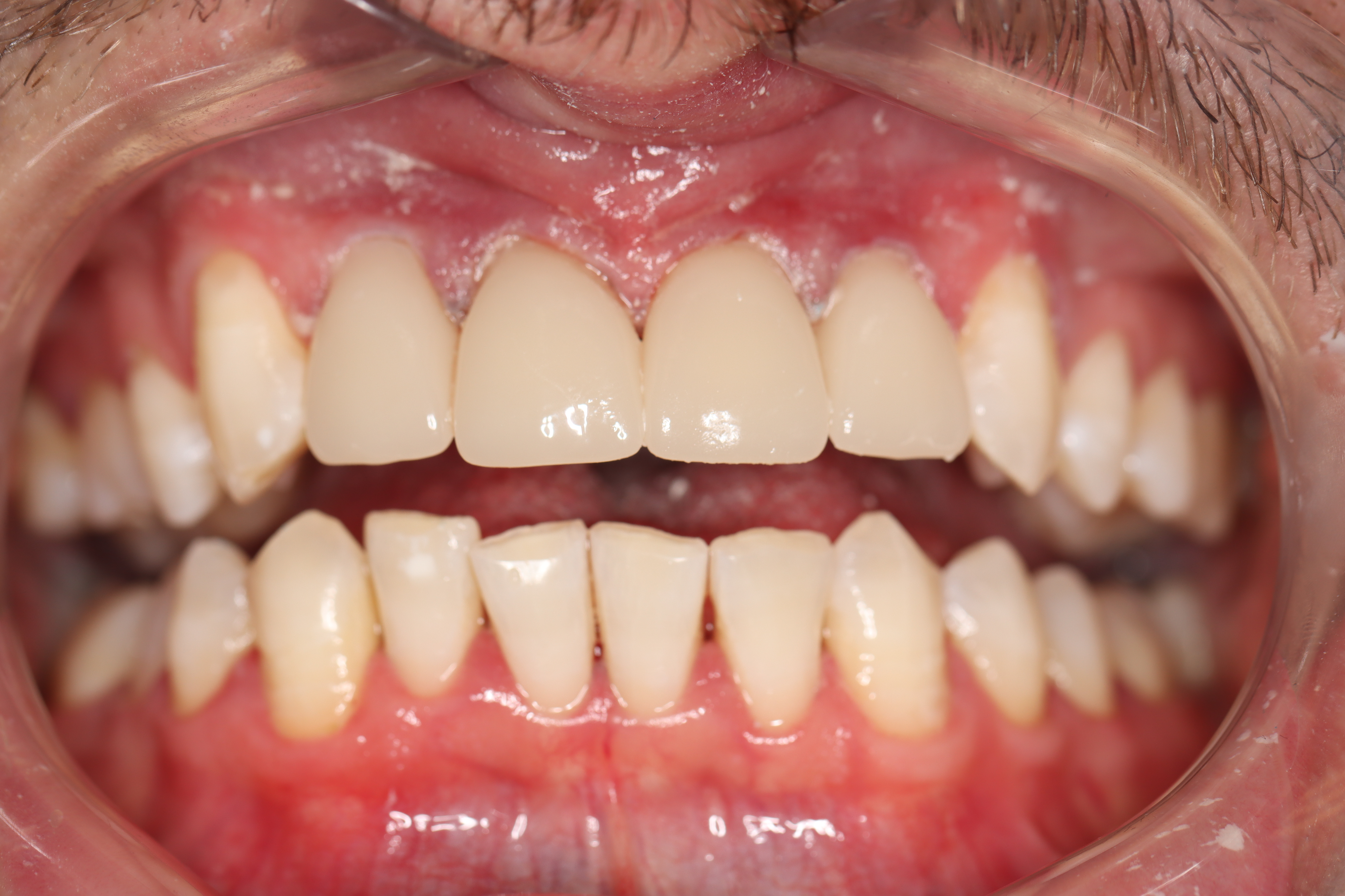 Cosmetic Dentistry: Dental Crowns after at Dr Chalita le Roux, Roodepoort (view 1)