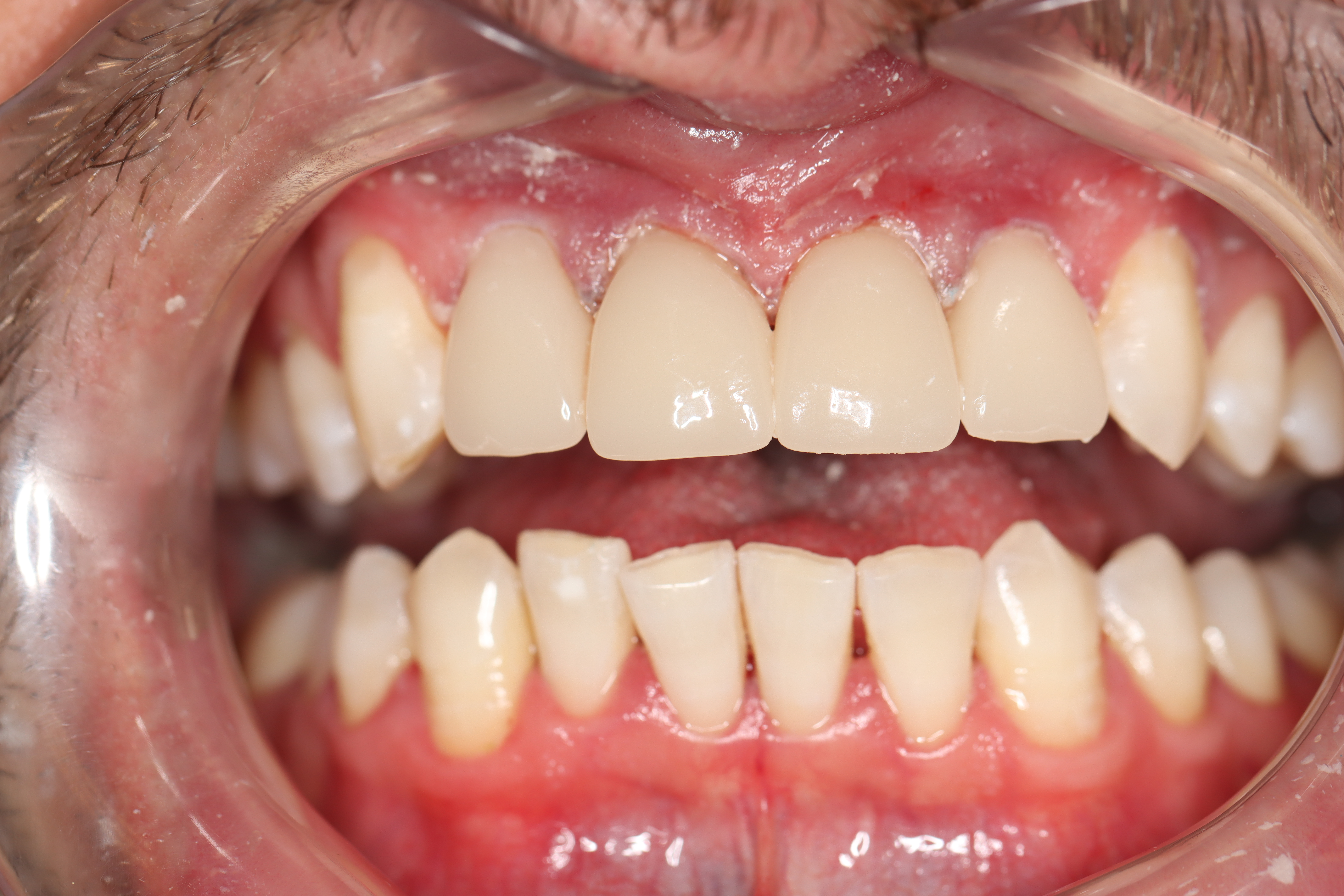 Cosmetic Dentistry: Dental Crowns after at Dr Chalita le Roux, Roodepoort (view 2)