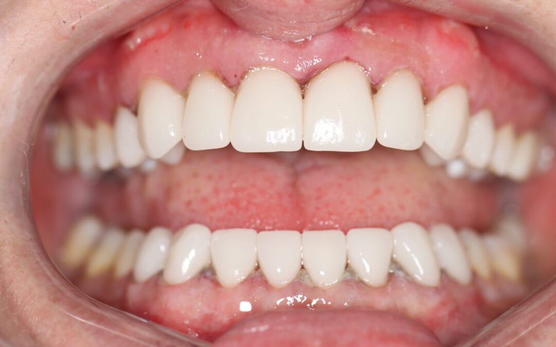 Smile Makeover Timeline Johannesburg (2025 | BIOLASE® & Same-Day Dentistry)