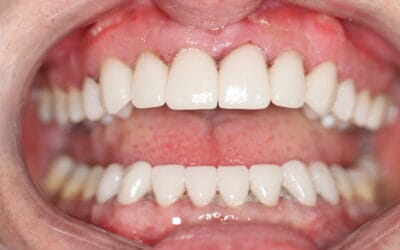 Smile Makeover Timeline Johannesburg (2025 | BIOLASE® & Same-Day Dentistry)