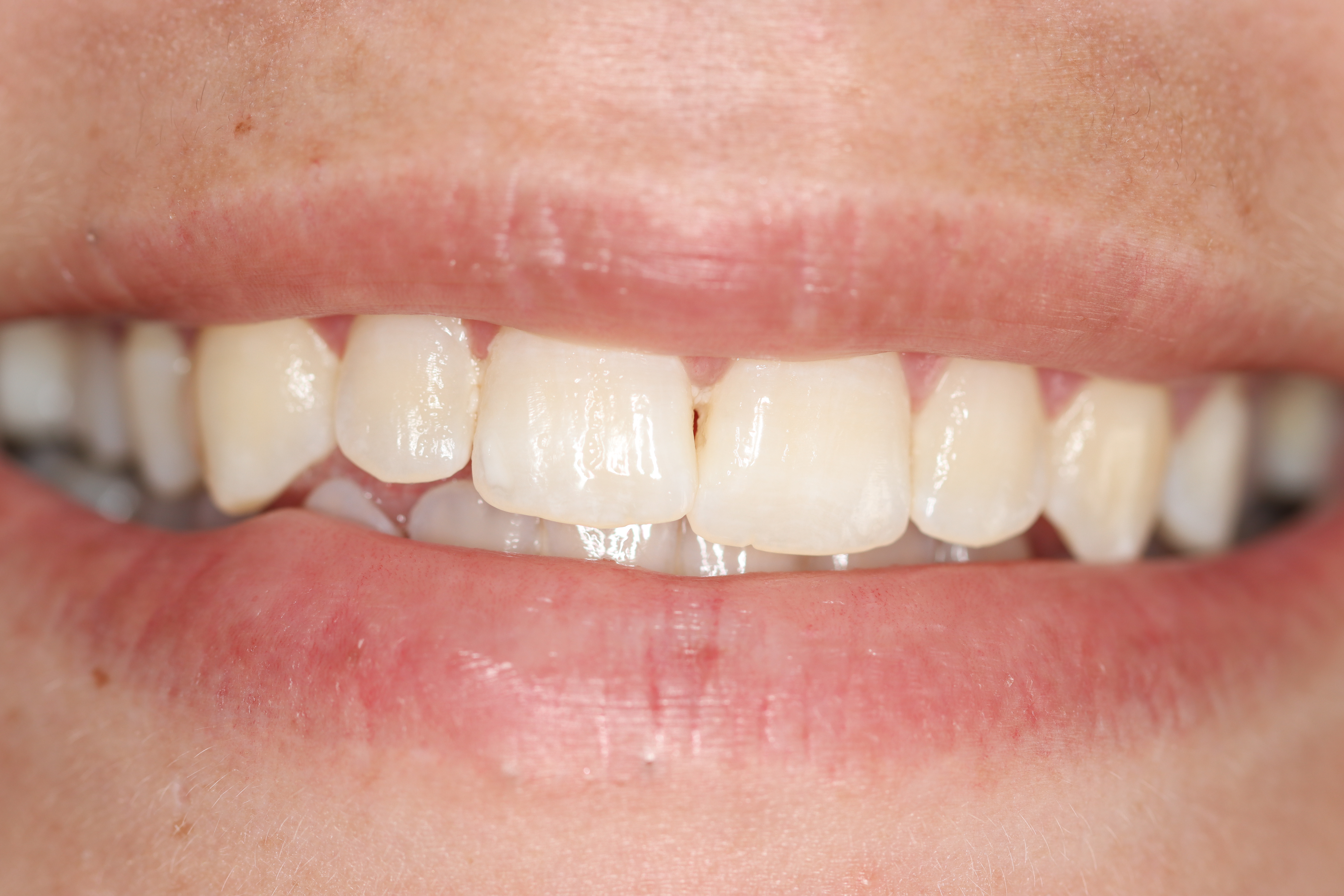 Biolase Whitening before at Dr Chalita le Roux, Roodepoort (view 1)