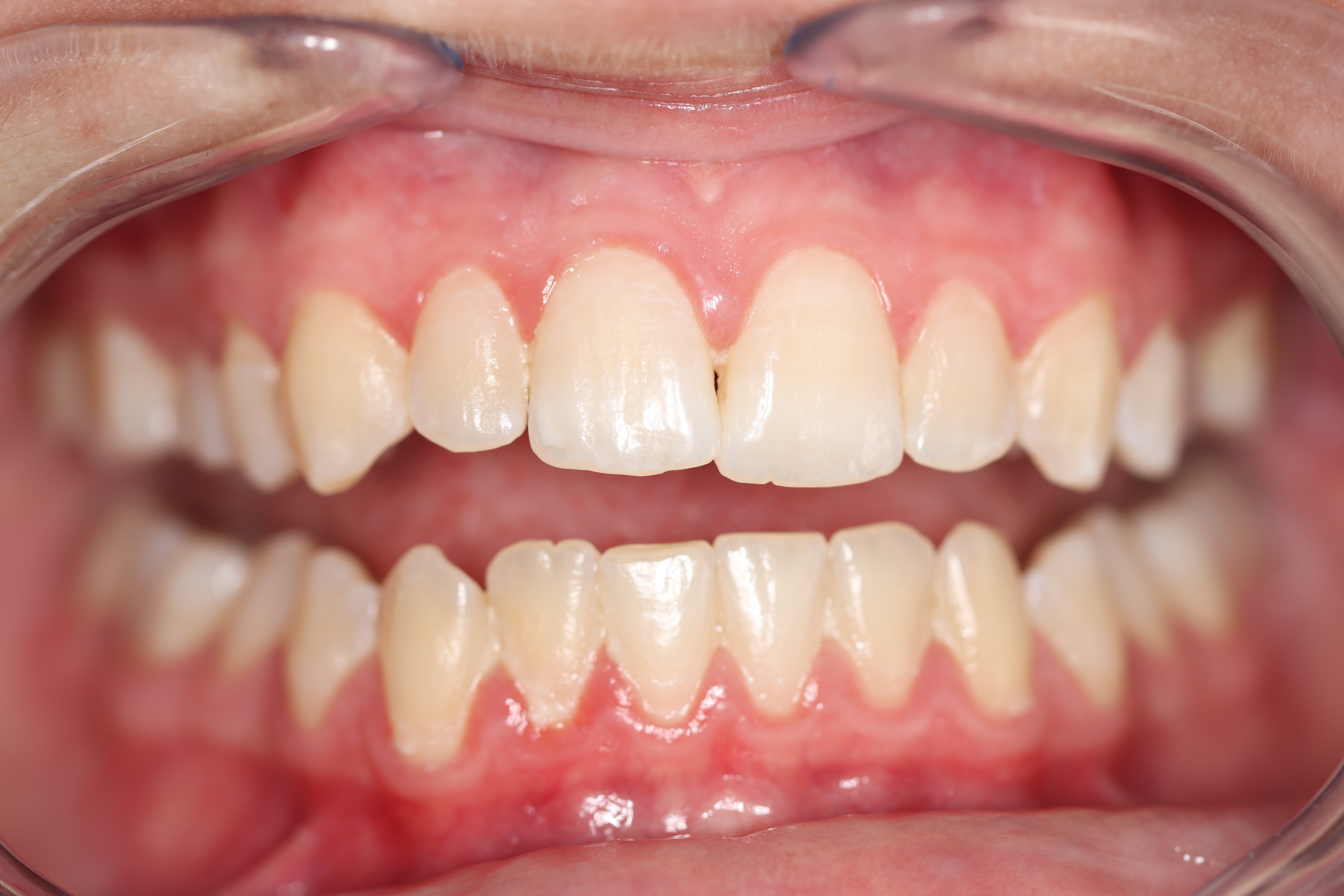 Biolase Whitening before at Dr Chalita le Roux, Roodepoort (view 2)