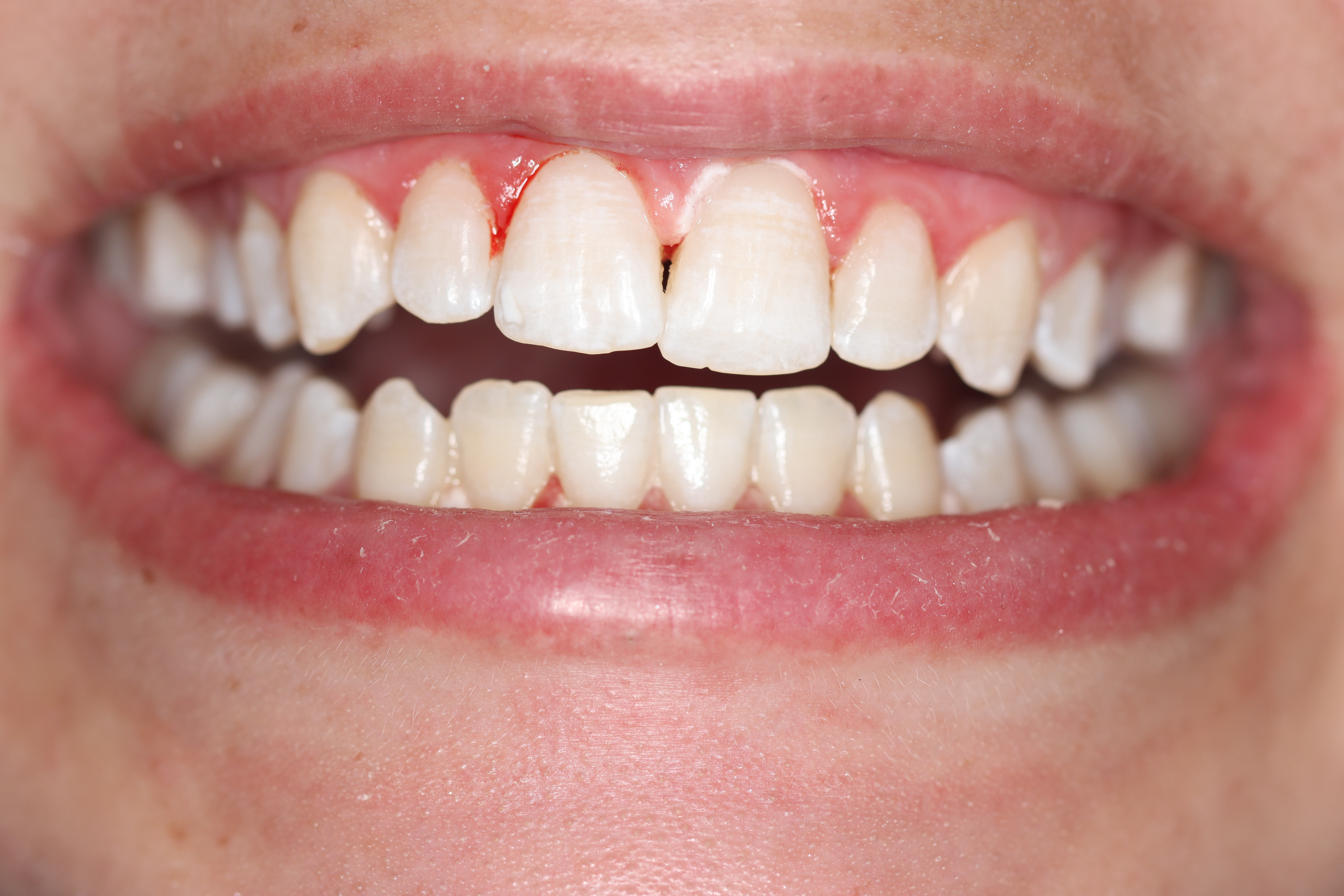 Biolase Whitening after at Dr Chalita le Roux, Roodepoort (view 1)