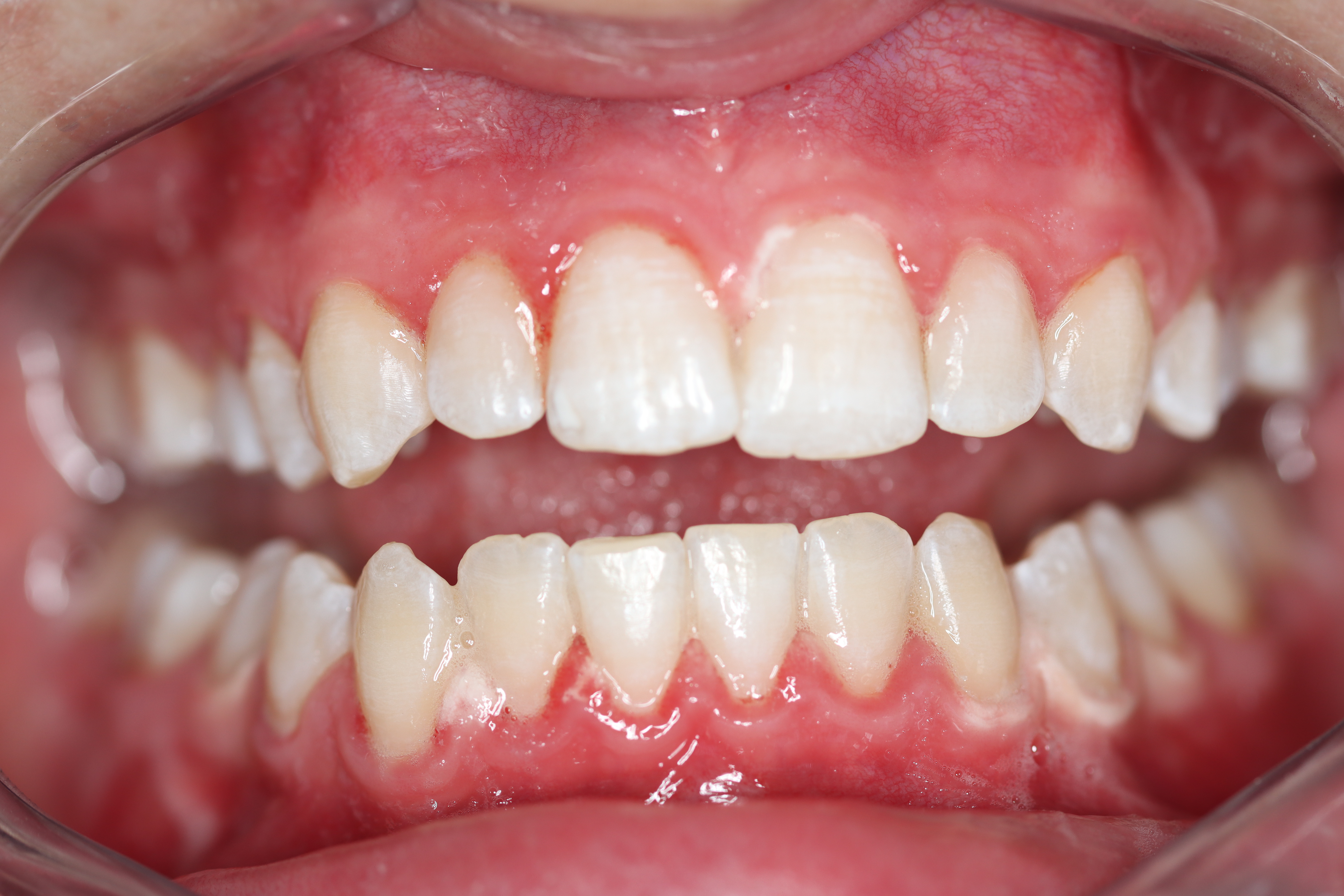 Biolase Whitening after at Dr Chalita le Roux, Roodepoort (view 2)