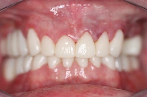 Smile Makeover after at Dr Chalita le Roux, Roodepoort (view 1)