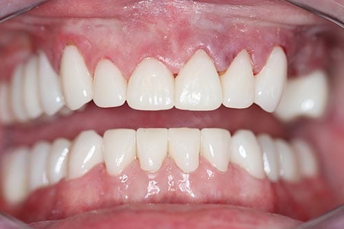 Smile Makeover after at Dr Chalita le Roux, Roodepoort (view 2)