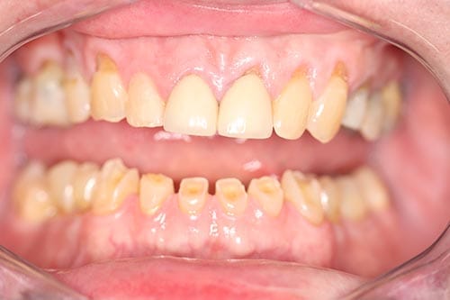 Smile Makeover before at Dr Chalita le Roux, Roodepoort (view 1)