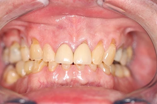Smile Makeover before at Dr Chalita le Roux, Roodepoort (view 2)