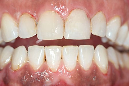 Teeth Whitening after at Dr Chalita le Roux, Roodepoort