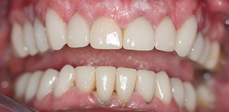 Smile Makeover after at Dr Chalita le Roux, Roodepoort