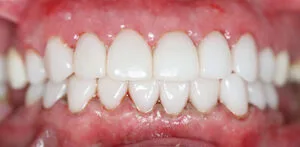 Patient smile after treatment at Dr Chalita le Roux, Roodepoort