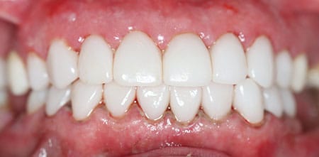 Smile Makeover after at Dr Chalita le Roux, Roodepoort (view 1)