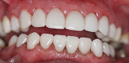 Smile Makeover after at Dr Chalita le Roux, Roodepoort (view 2)
