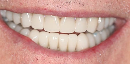 Smile Makeover after at Dr Chalita le Roux, Roodepoort (view 1)