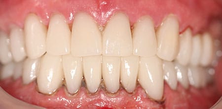 Smile Makeover after at Dr Chalita le Roux, Roodepoort (view 2)