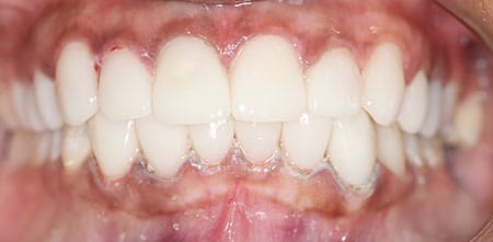Smile Makeover after at Dr Chalita le Roux, Roodepoort (view 1)