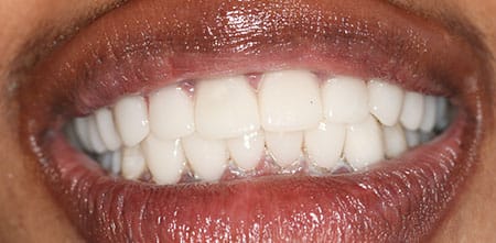 Smile Makeover after at Dr Chalita le Roux, Roodepoort (view 2)