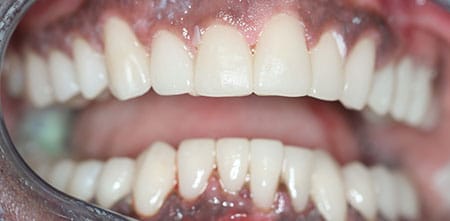 Smile Makeover after at Dr Chalita le Roux, Roodepoort