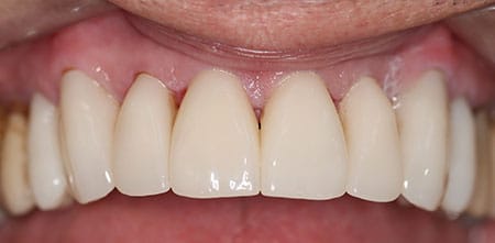 Cosmetic Dentistry: Upper Anterior Crowns after at Dr Chalita le Roux, Roodepoort
