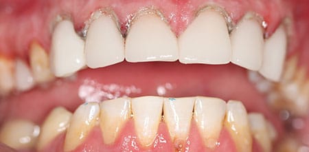 Cosmetic Dentistry: Upper Anterior Crowns after at Dr Chalita le Roux, Roodepoort