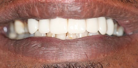 Cosmetic Dentistry: Upper Anterior Crowns after at Dr Chalita le Roux, Roodepoort (view 1)