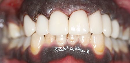 Cosmetic Dentistry: Upper Anterior Crowns after at Dr Chalita le Roux, Roodepoort (view 2)