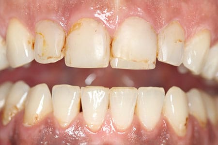 Teeth Whitening before at Dr Chalita le Roux, Roodepoort
