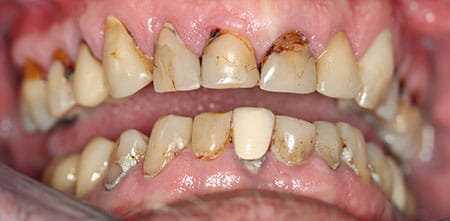 Smile Makeover before at Dr Chalita le Roux, Roodepoort