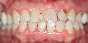 Patient smile before treatment at Dr Chalita le Roux, Roodepoort