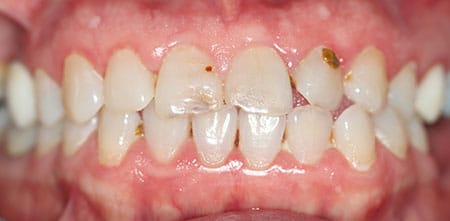 Smile Makeover before at Dr Chalita le Roux, Roodepoort (view 1)