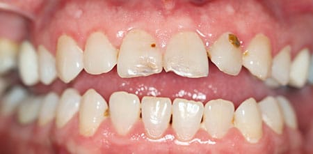 Smile Makeover before at Dr Chalita le Roux, Roodepoort (view 2)