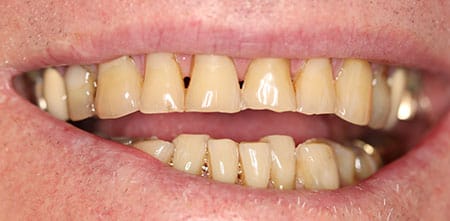 Smile Makeover before at Dr Chalita le Roux, Roodepoort (view 1)