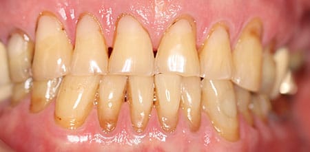 Smile Makeover before at Dr Chalita le Roux, Roodepoort (view 2)