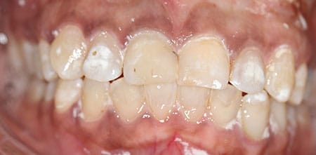 Smile Makeover before at Dr Chalita le Roux, Roodepoort (view 1)