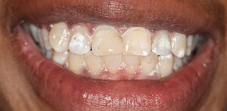 Smile Makeover before at Dr Chalita le Roux, Roodepoort (view 2)