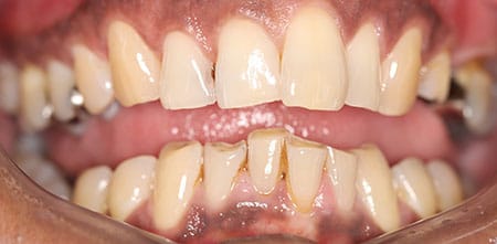 Smile Makeover before at Dr Chalita le Roux, Roodepoort