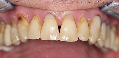 Cosmetic Dentistry: Upper Anterior Crowns before at Dr Chalita le Roux, Roodepoort