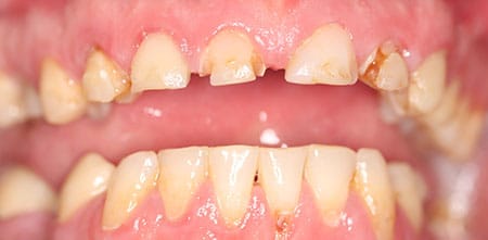 Cosmetic Dentistry: Upper Anterior Crowns before at Dr Chalita le Roux, Roodepoort