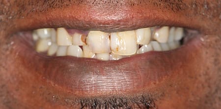 Cosmetic Dentistry: Upper Anterior Crowns before at Dr Chalita le Roux, Roodepoort (view 1)