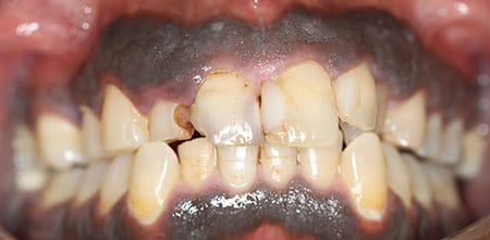 Cosmetic Dentistry: Upper Anterior Crowns before at Dr Chalita le Roux, Roodepoort (view 2)