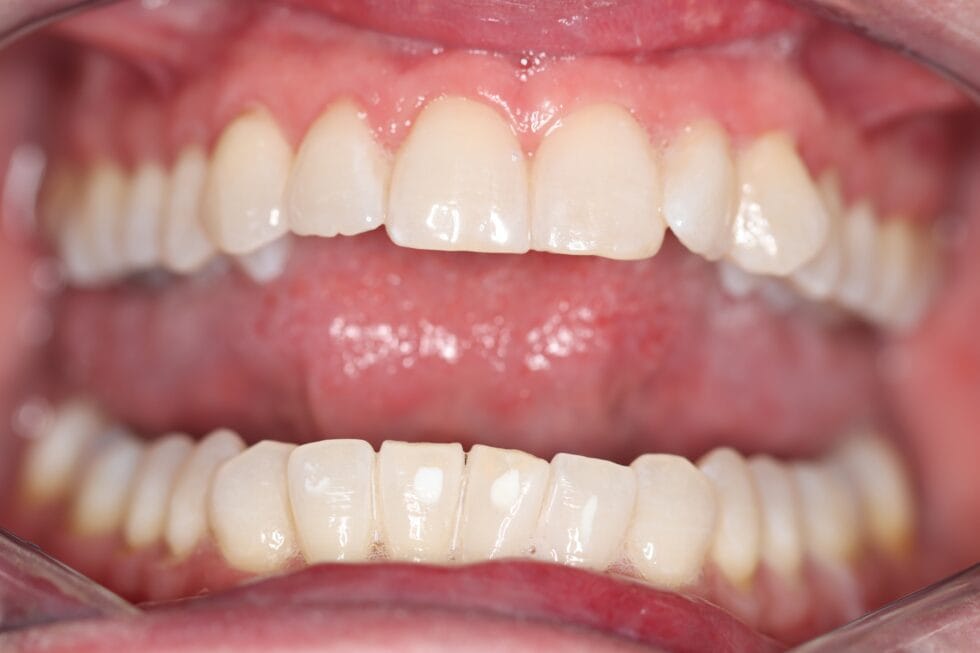 After professional teeth whitening at Dr Chalita le Roux Dental Practice in Roodepoort